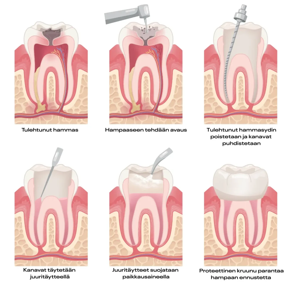 Mitä hampaan juurihoito on ja miksi se on tarpeen? 3 Juurihoidon kuusi vaihetta hammaslääketieteessä: tulehduksen tunnistaminen, juurikanavan avaus, kanavan puhdistus, kanavan muotoilu, juuritäyte ja lopullinen kruunu hoidettuun hampaaseen.