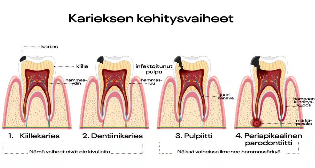 Mitä hampaan juurihoito on ja miksi se on tarpeen? 1 Karieksen kehitysvaiheet hampaassa: alkaen kiilteen demineralisaatiosta, edeten dentiiniin, pulpaan ja lopulta mahdolliseen juurikanavan tulehdukseen - havainnollistava lääketieteellinen kuvasarja hammaslääkäreille ja potilaille