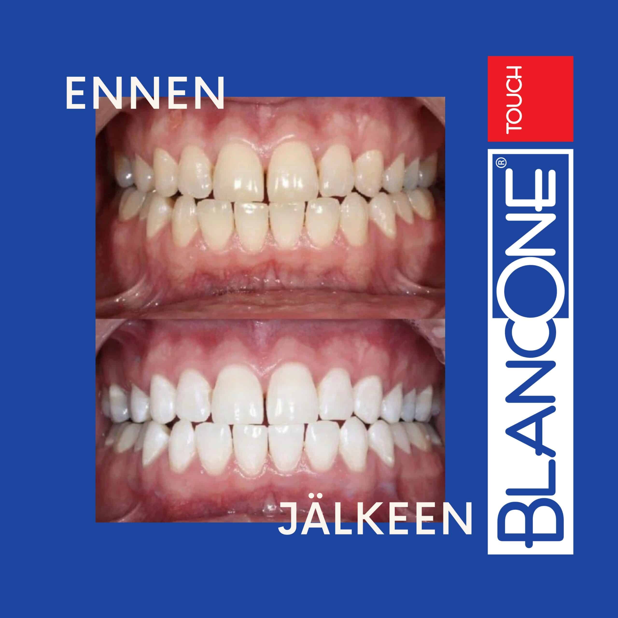 Ennen ja jälkeen kuva TOUCH