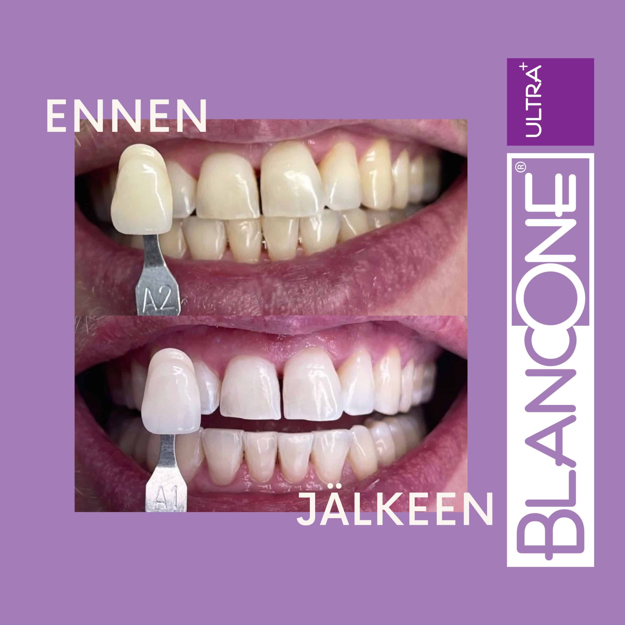 Ennen ja jalkeen kuva ULTRA scaled