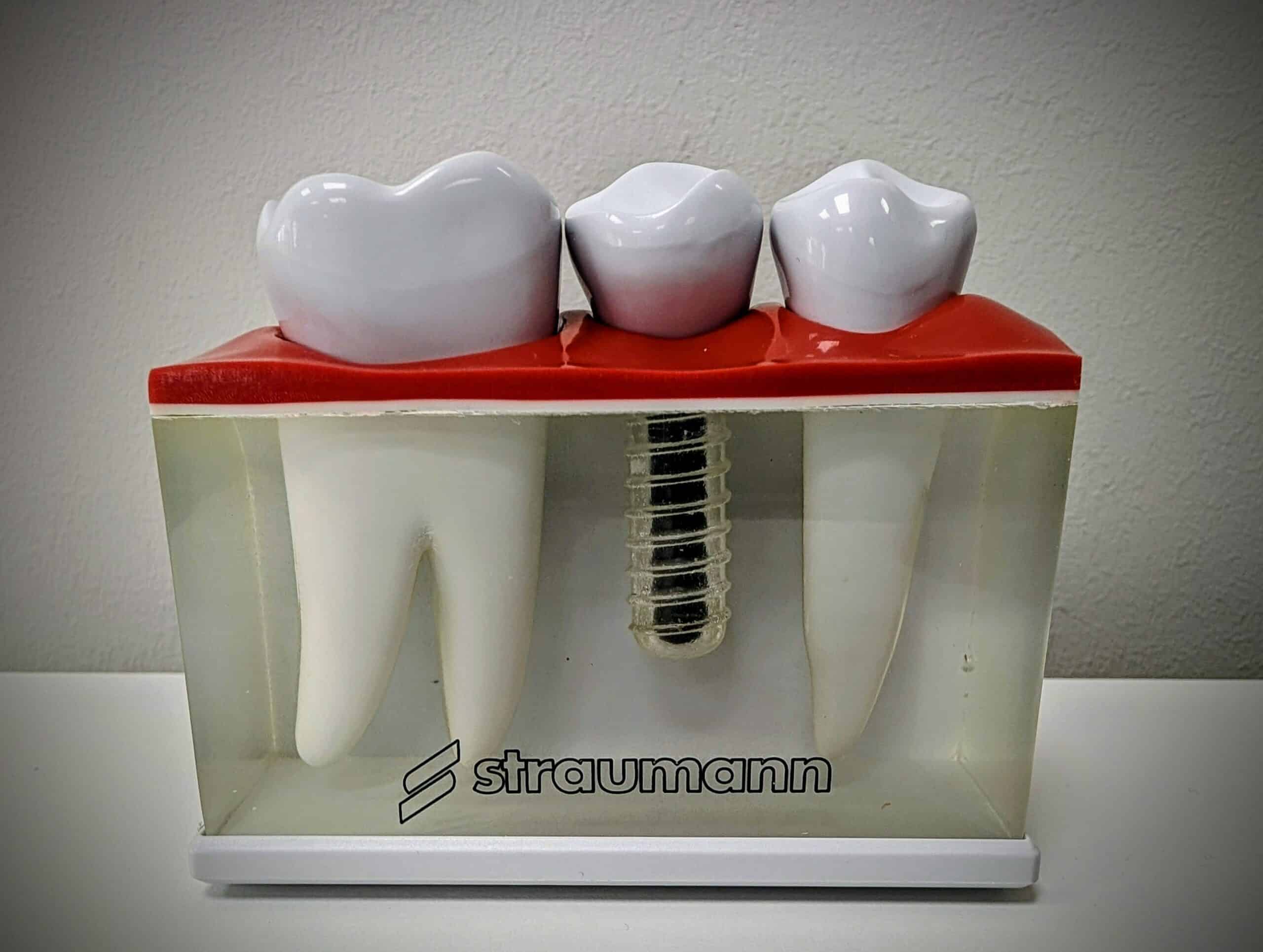 hammas implantti luonnoskuva